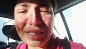 Boşandığı eşinden şiddet gören Sibel, sosyal medyadan yardım istedi