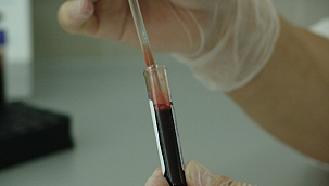 'Pankreas kanserinin görülme sıklığı artıyor'