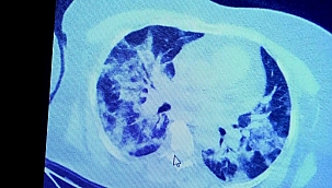 İlaç kullanan korona hastaları ile kullanmayanlar arasındaki inanılmaz